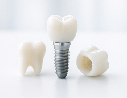 インプラントのメリットは何ですか？