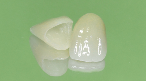 セラミック以外の選択肢も相談できますか