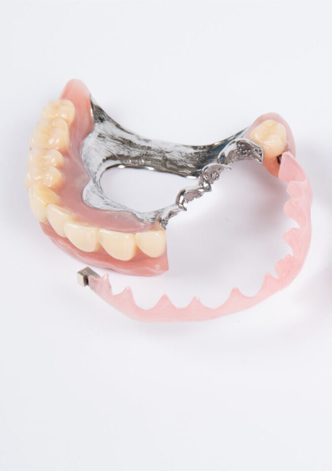 従来の精密入れ歯(コーヌスクローネやテレスコープ)にはどんな課題があったのですか?